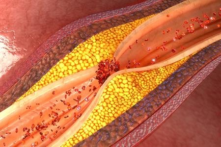 A lifelike illustration of a red artery blocked with yellow 